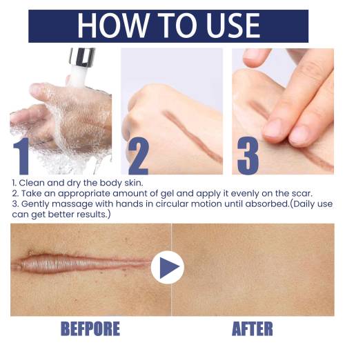 Silikone ar-plejegel