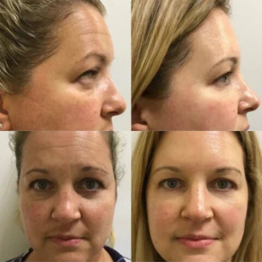 SkinLift ansigtsserum til fugt og glattere udseende