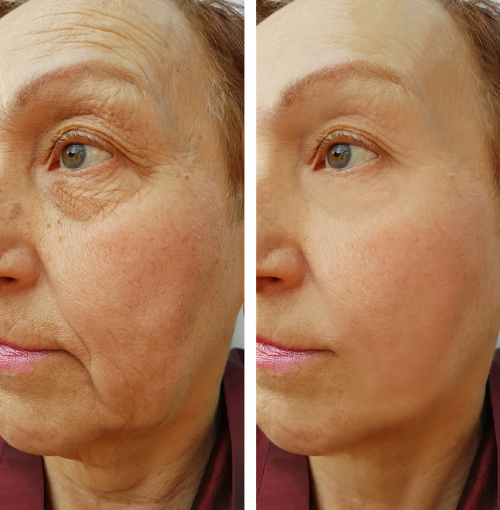 SkinYouth mikroinfusionsserum til kosmetisk hudpleje
