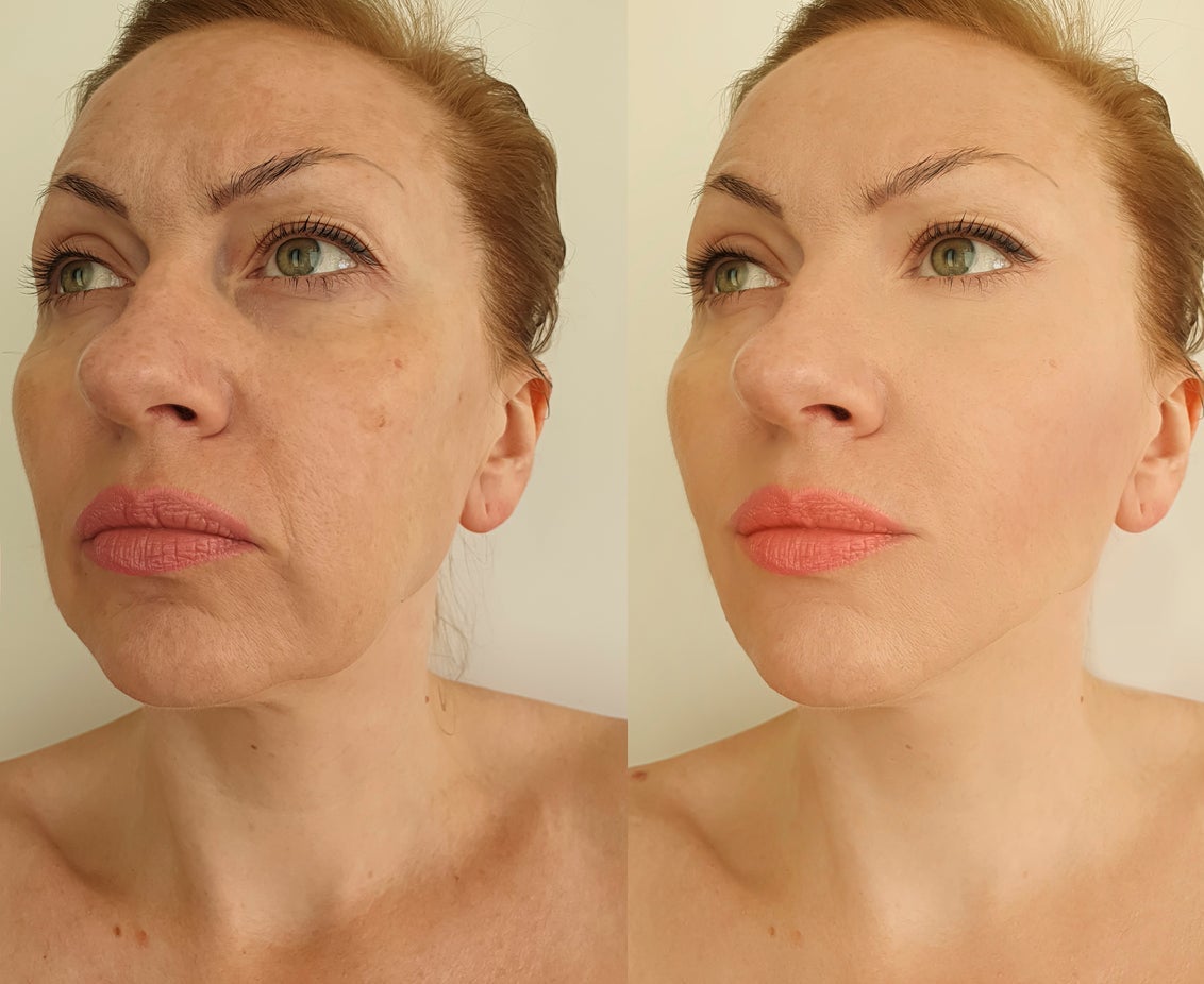 SkinYouth mikroinfusionsserum til kosmetisk hudpleje