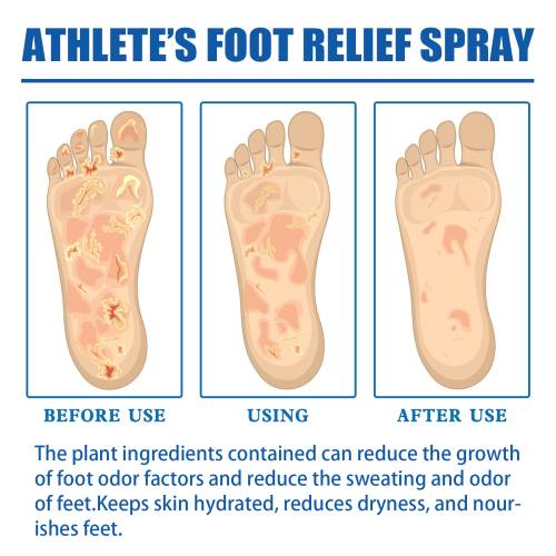 Allantoin fodplejespray