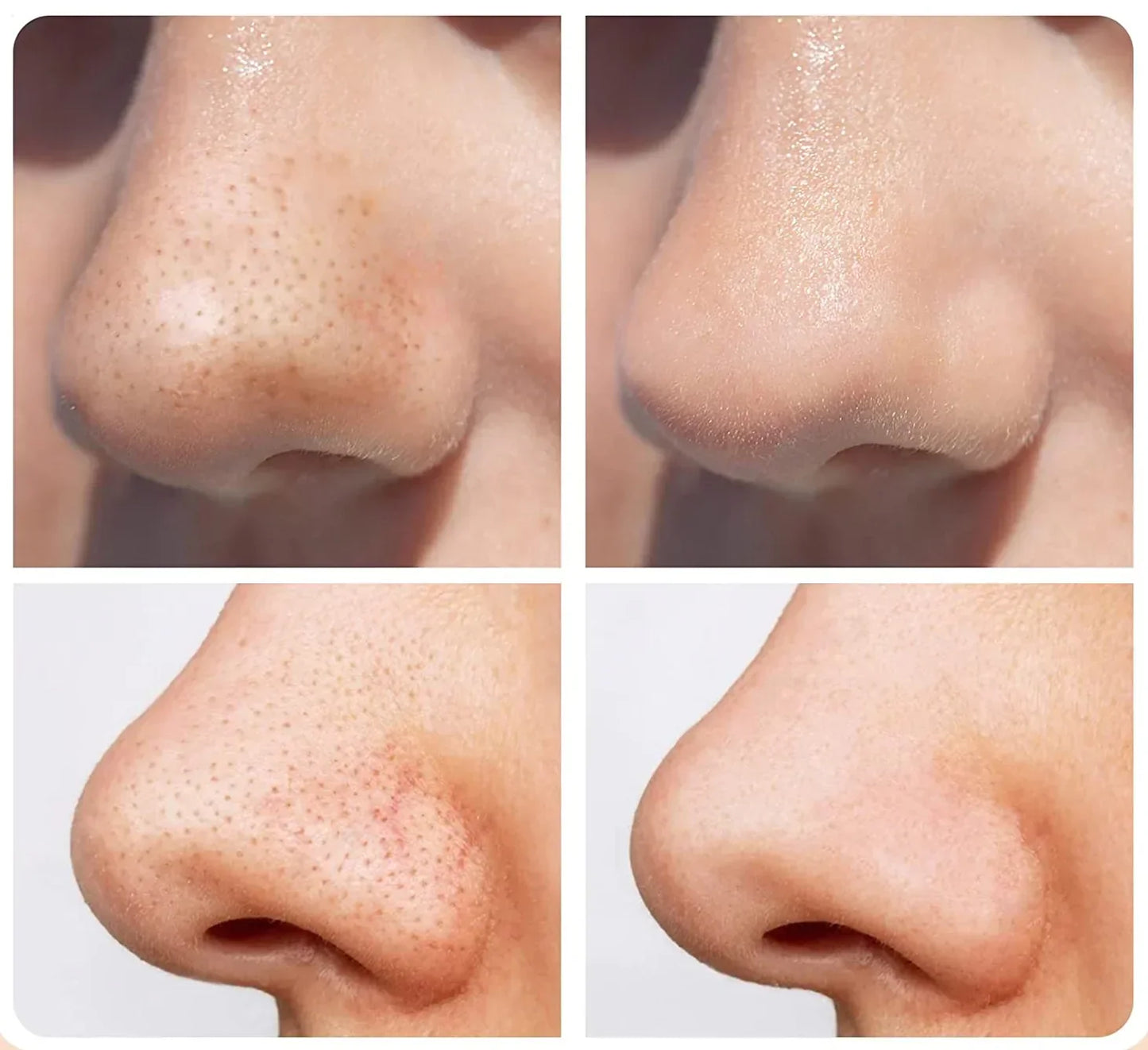 Derm vakuum hudrenser til porer og eksfoliering – ekstra produktvisning