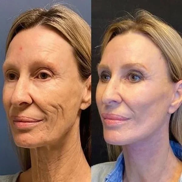 SkinLift ansigtsserum til fugt og glattere udseende