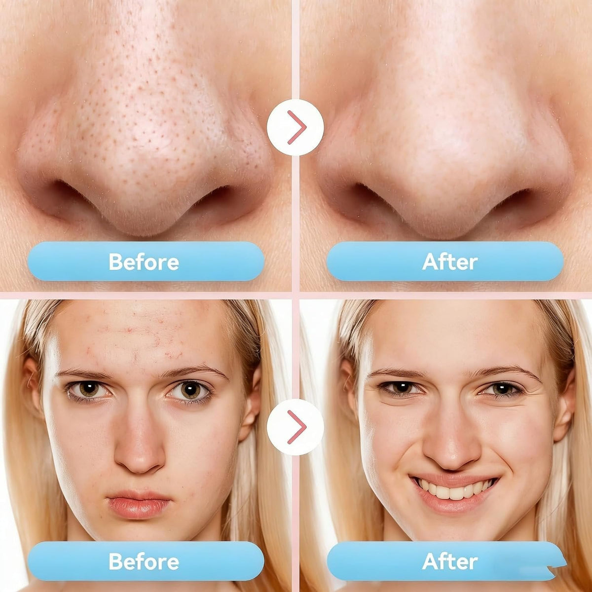 PoreCleaner - Stærk Sugestyrke Blackhead Fjerner Og Pore Renser