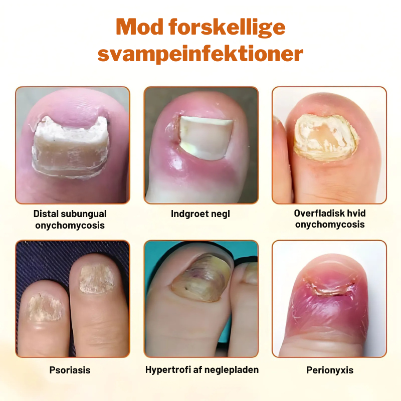 Avanceret Svampedræbende Negleplejespray