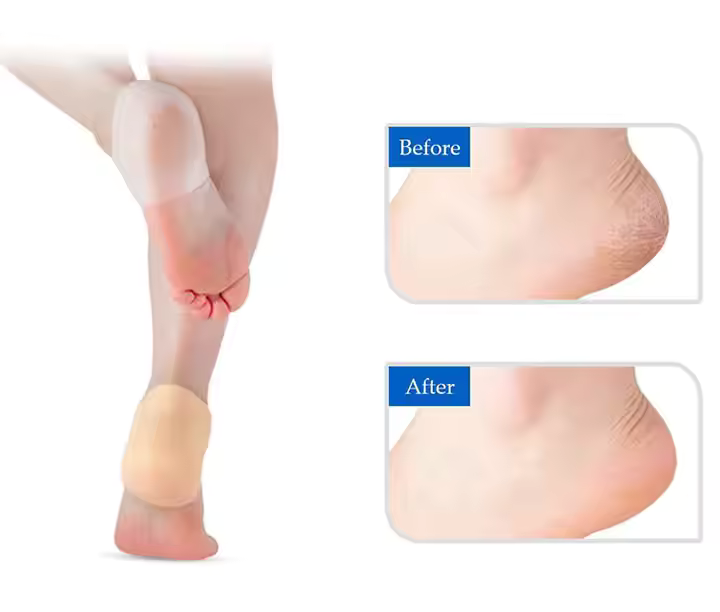 Happy™ HeelProtector 1+1 GRATIS - Blød Silikone Hæl Beskytter