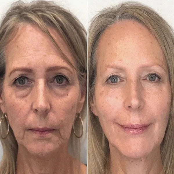 SkinLift ansigtsserum til fugt og glattere udseende