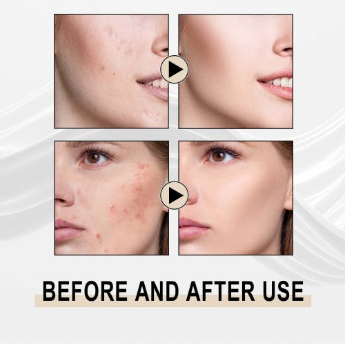Glykolsyre peeling-essens mod hudorme