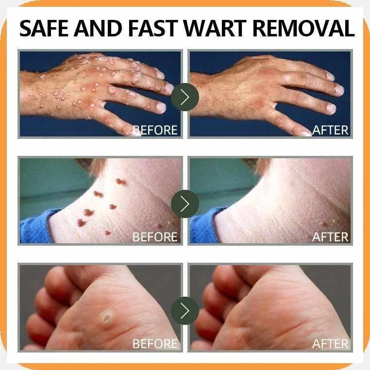 WartRemover 1+1 GRATIS: Sikker Hudvorte Salve Fjerner
